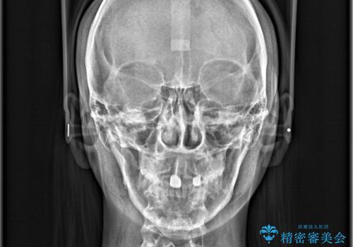 後戻りした歯並びをきれいにしたいの治療後