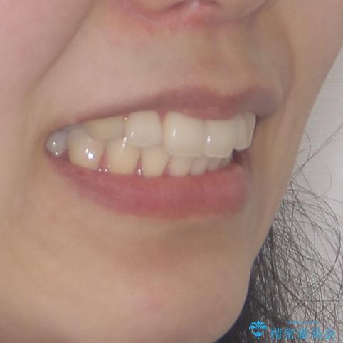 再矯正で突出した口元を引っ込める 抜歯矯正の後戻りの治療前(顔貌)