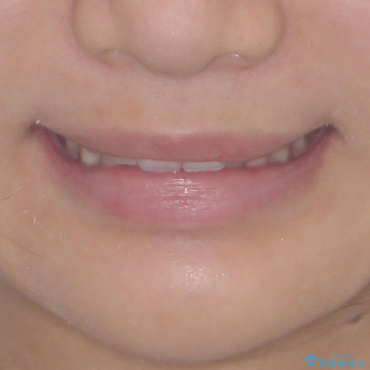 飛び出した前歯と黄ばんだ歯 ホワイトニングしながらマウスピース矯正の治療後(顔貌)