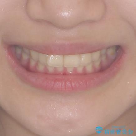 飛び出した前歯と黄ばんだ歯 ホワイトニングしながらマウスピース矯正の治療前(顔貌)