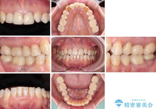 奥歯の銀歯と歯並びを改善　歯周外科治療と矯正治療を行った総合歯科診療の治療後