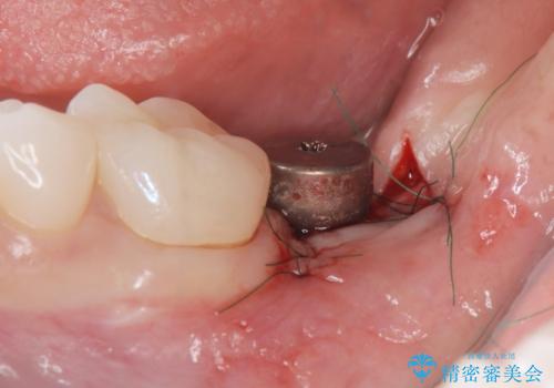 [ インプラント治療 ]  失った歯の咬合機能回復の治療中