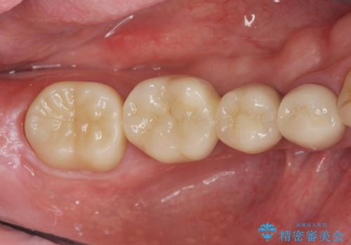 長いブリッジをインプラント補綴への変更の治療後