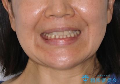 下の前歯が見えない:深い噛み合わせもインビザラインでの治療後(顔貌)