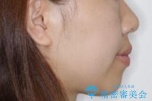 オープンバイト(開咬)を非抜歯インビザラインで治すの治療前(顔貌)