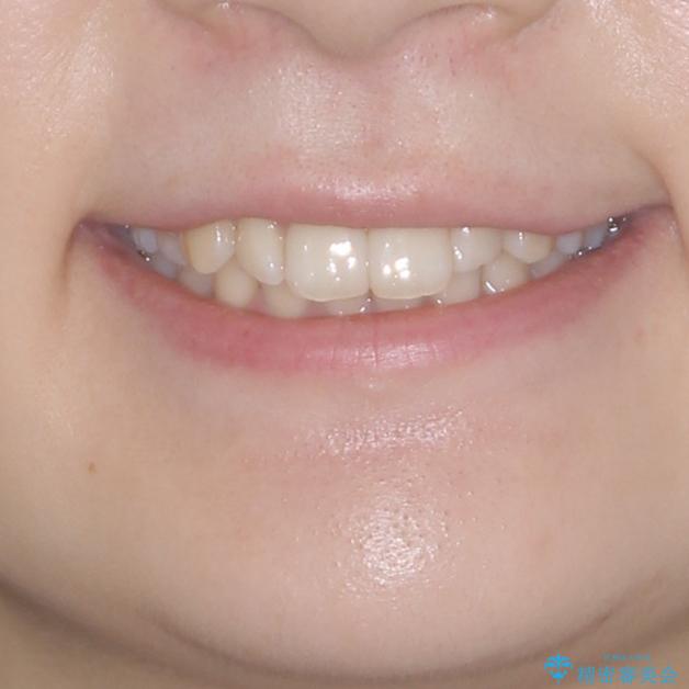 インビザラインを断念 ワイヤー装置で楽々と矯正治療の治療前(顔貌)