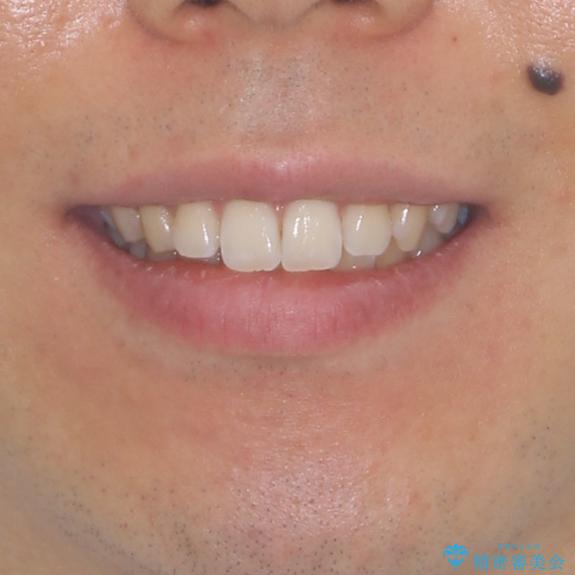 前歯のデコボコと突出感 インビザラインにて矯正治療の治療前(顔貌)