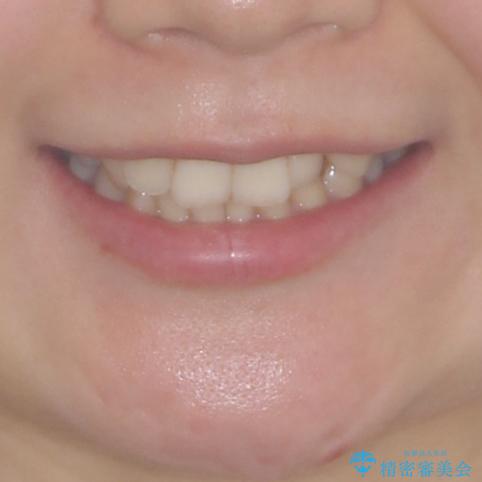 入国制限で帰国できず 海外出張中のインビザライン矯正の治療前(顔貌)