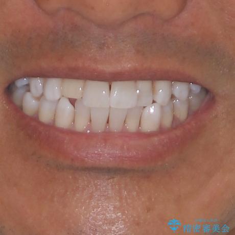治療途中の前歯を治したい インビザライン矯正とオールセラミッククラウンの治療前(顔貌)