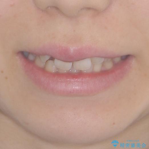 変則的な抜歯矯正 八重歯を抜いてしまった人のワイヤー矯正の治療前(顔貌)