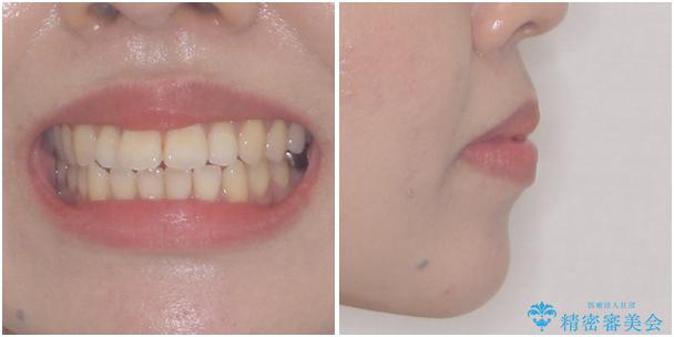 閉じにくい唇を抜歯矯正で閉じやすく 目だたないワイヤー矯正の治療前(顔貌)