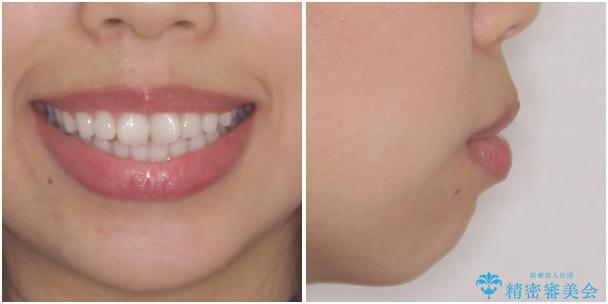 目立たない装置で横顔のシルエットを改善 ハーフリンガルでの抜歯矯正の治療前(顔貌)