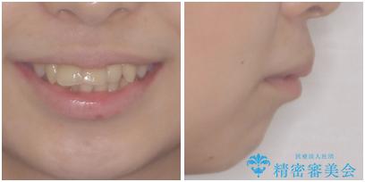 出っ歯を治したい ワイヤー装置による抜歯矯正の治療前(顔貌)