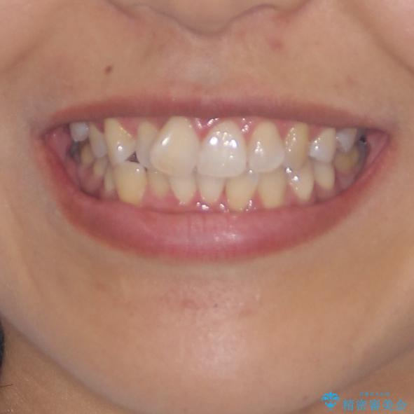 前歯のデコボコをインビザラインでスッキリと仕上げるの治療前(顔貌)