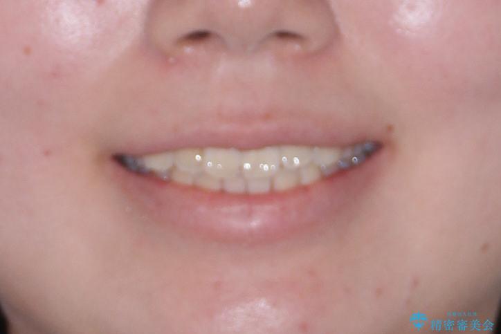 【インビザライン】前歯の凸凹をなおしたいの治療前(顔貌)