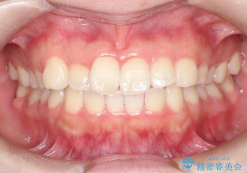 【インビザライン】前歯の凸凹をなおしたいの症例 治療前