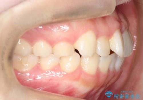 【インビザライン】前歯の凸凹をなおしたいの治療前