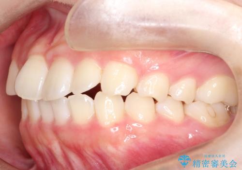 【インビザライン】前歯の凸凹をなおしたいの治療前