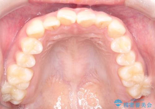 【インビザライン】前歯の凸凹をなおしたいの治療前