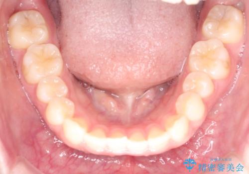 【インビザライン】前歯の凸凹をなおしたいの治療前