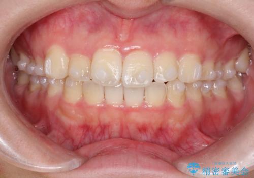 【インビザライン】前歯の凸凹をなおしたいの治療中