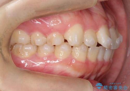 【インビザライン】前歯の凸凹をなおしたいの治療中