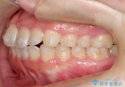 【インビザライン】前歯の凸凹をなおしたいの治療中