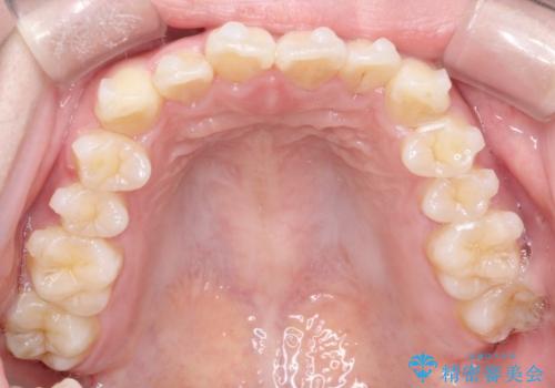 【インビザライン】前歯の凸凹をなおしたいの治療中