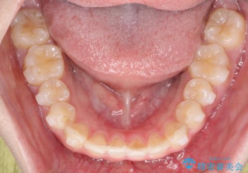 【インビザライン】前歯の凸凹をなおしたいの治療中