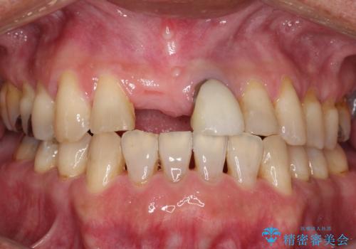 【オールセラミックスタンダード】前歯のブリッジの症例 治療前