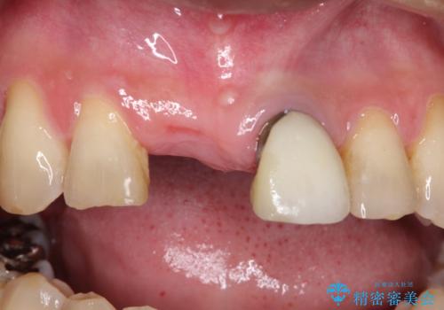 【オールセラミックスタンダード】前歯のブリッジの治療前