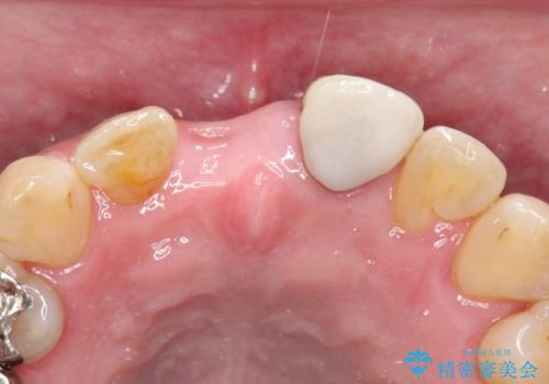 【オールセラミックスタンダード】前歯のブリッジの治療前