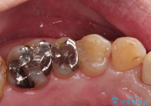 銀歯がとれた!セラミックインレーによる修復の治療前