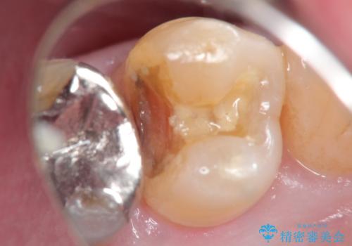 銀歯がとれた!セラミックインレーによる修復の治療中