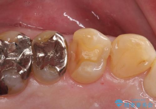 銀歯がとれた!セラミックインレーによる修復の治療中