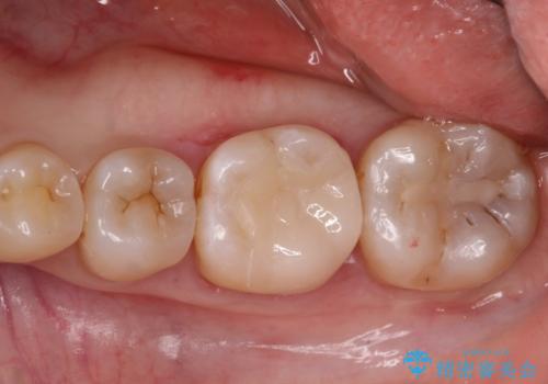 【セラミックインレー】虫歯の治療の症例 治療後