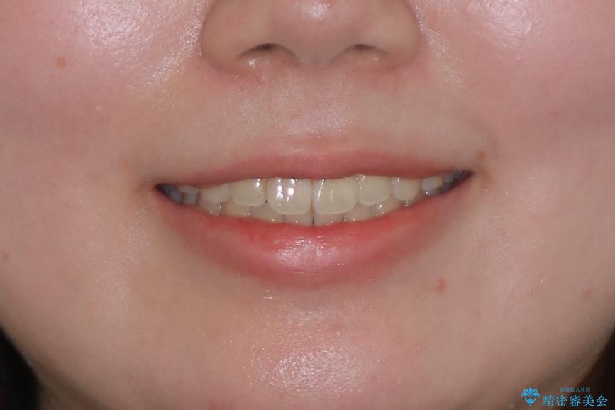 【インビザライン】前歯の凸凹をなおしたいの治療後(顔貌)