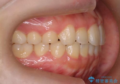 【インビザライン】前歯の凸凹をなおしたいの治療後