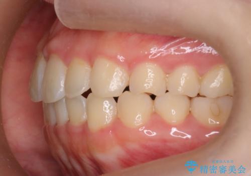 【インビザライン】前歯の凸凹をなおしたいの治療後