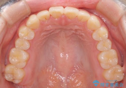 【インビザライン】前歯の凸凹をなおしたいの治療後