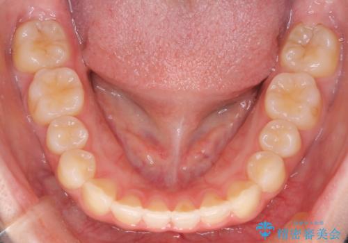 【インビザライン】前歯の凸凹をなおしたいの治療後