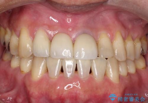【オールセラミックスタンダード】前歯のブリッジの症例 治療後