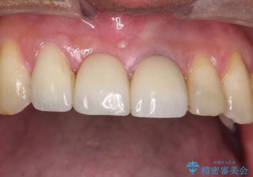 【オールセラミックスタンダード】前歯のブリッジの治療後