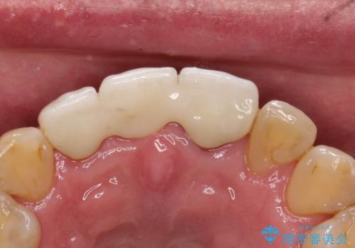 【オールセラミックスタンダード】前歯のブリッジの治療後