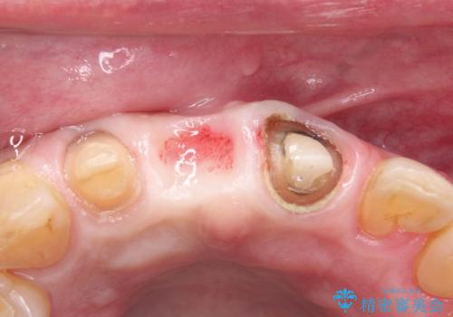 【オールセラミックスタンダード】前歯のブリッジの治療中
