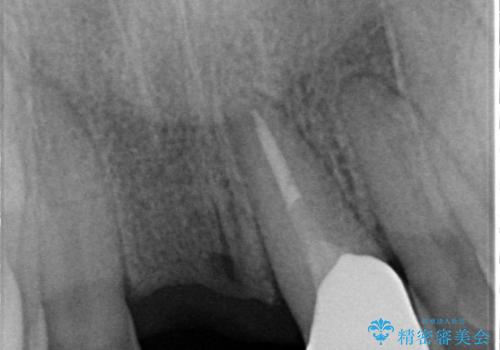 【オールセラミックスタンダード】前歯のブリッジの治療前