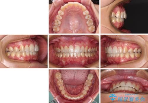 前歯のデコボコをインビザラインでスッキリと仕上げるの治療後