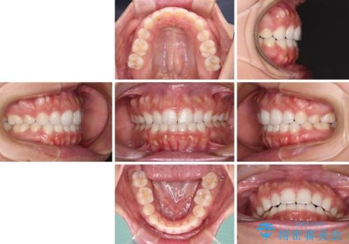 目立たない装置で横顔のシルエットを改善 ハーフリンガルでの抜歯矯正の治療後