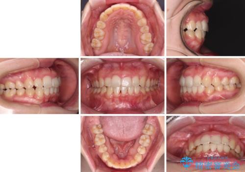 変則的な抜歯矯正 八重歯を抜いてしまった人のワイヤー矯正の治療後