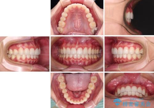 飛び出した前歯と黄ばんだ歯 ホワイトニングしながらマウスピース矯正の治療後